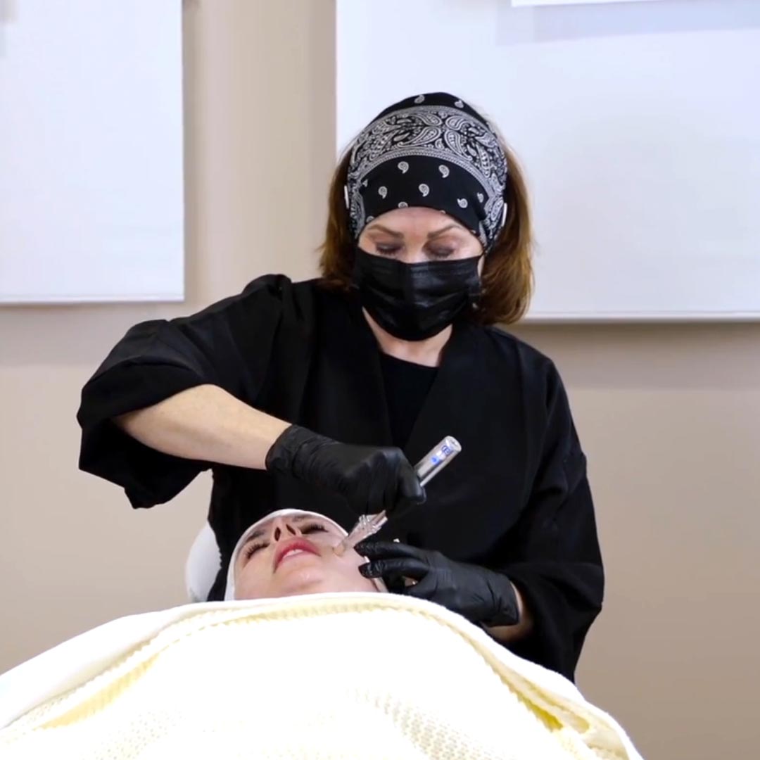 kdo může provádět mezotrapii microneedling mikrojehličkování